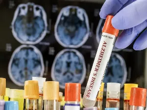 AI-Enhanced Blood Test Detects Alzheimer's Disease Early in India