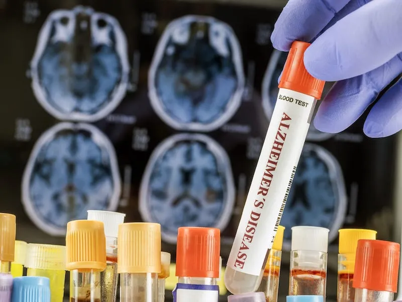 AI-Enhanced Blood Test Detects Alzheimer's Disease Early in India