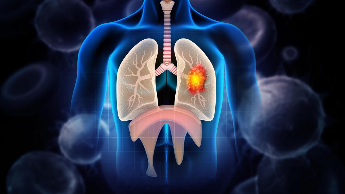 Non-Smokers and Lung Cancer: Insights from Dr Manish Kumar Aggarwal