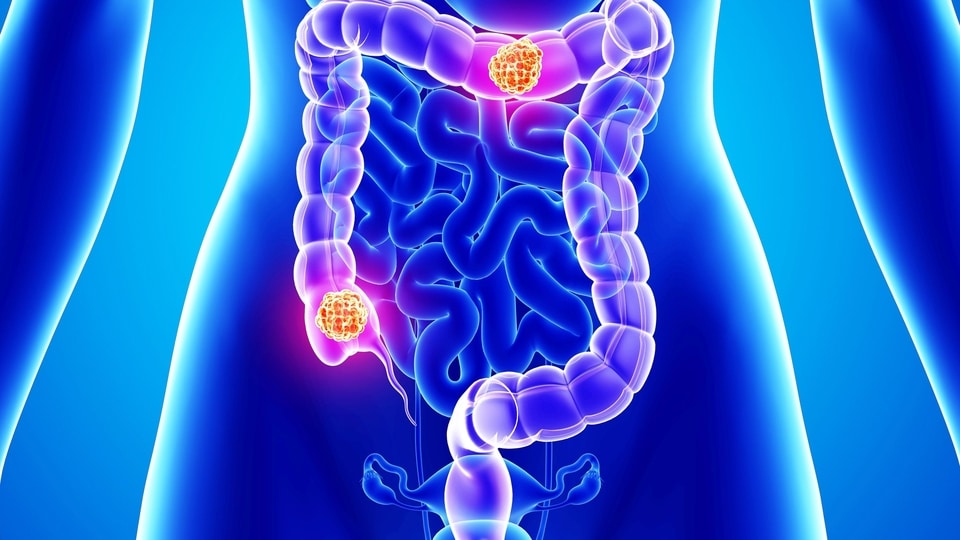 Research Discovers Role of Protein ZFP36L2 in Colorectal Cancer Spread