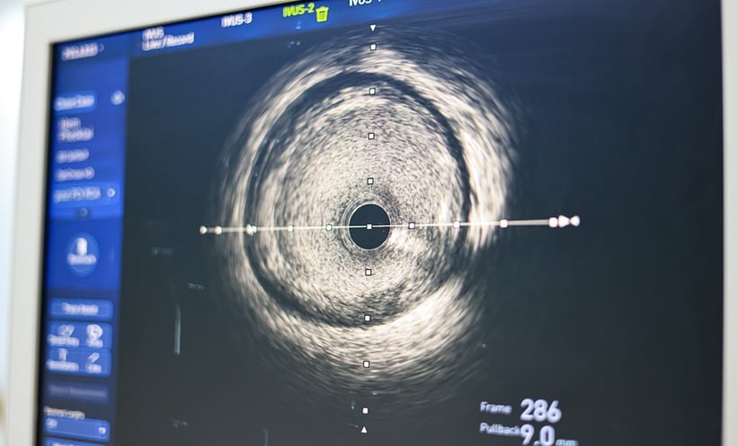 Study Reveals Widespread Silent Atherosclerosis Among Adults