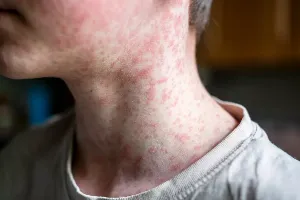 WHO Meeting Addressing Measles Outbreaks in South-East Asia