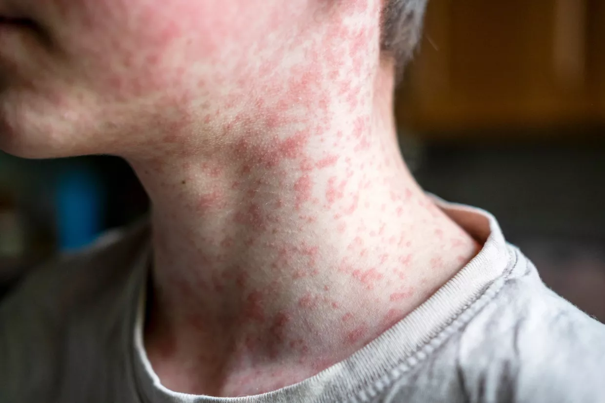 WHO Meeting Addressing Measles Outbreaks in South-East Asia