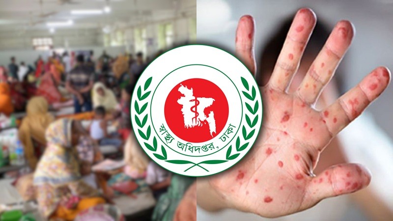 Bangladesh Faces Severe Measles Outbreak with High Child Mortality