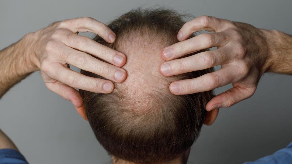 Men's Hair Loss: Causes in Their 20s and 30s Explained