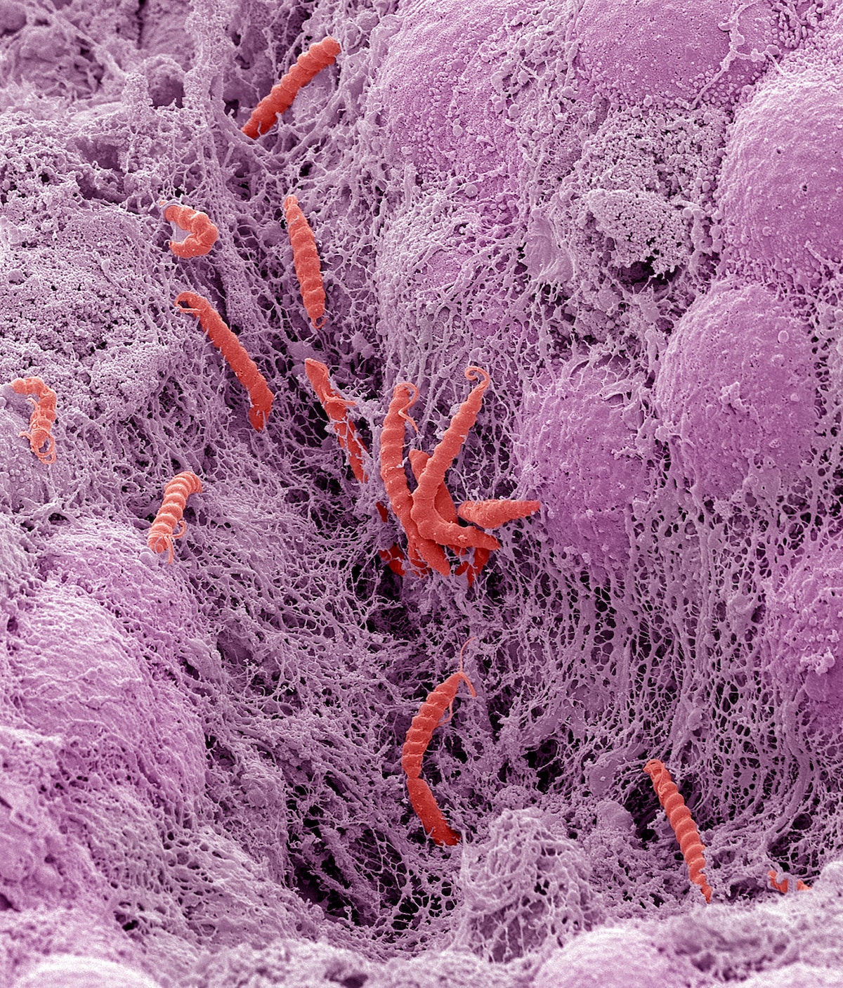 Global Report: 12% of Cancer Cases Linked to Infections in 2024